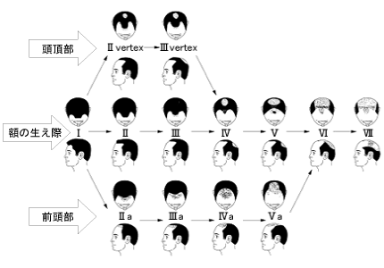 男性型脱毛症の進行パターン